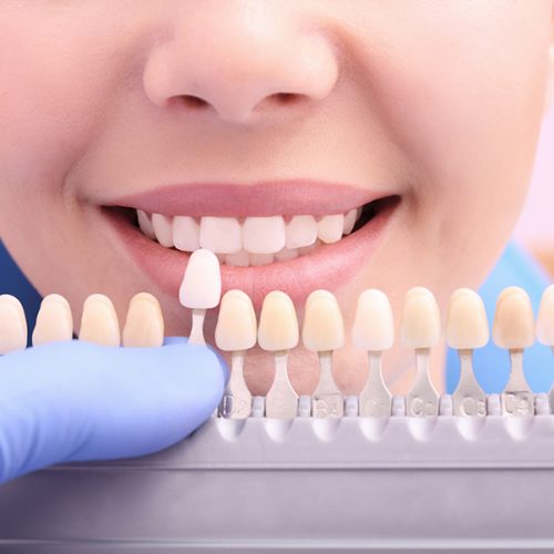 Implantes dentales en Chamberí - Baquero Odontología Familiar