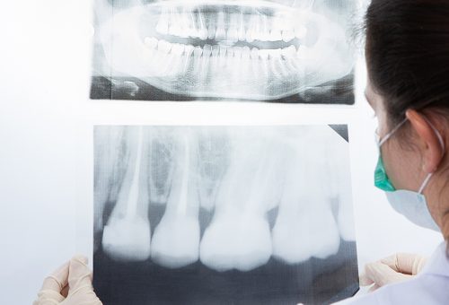 Mínima radiación computarizada en Chamberí - Baquero Odontología Familiar