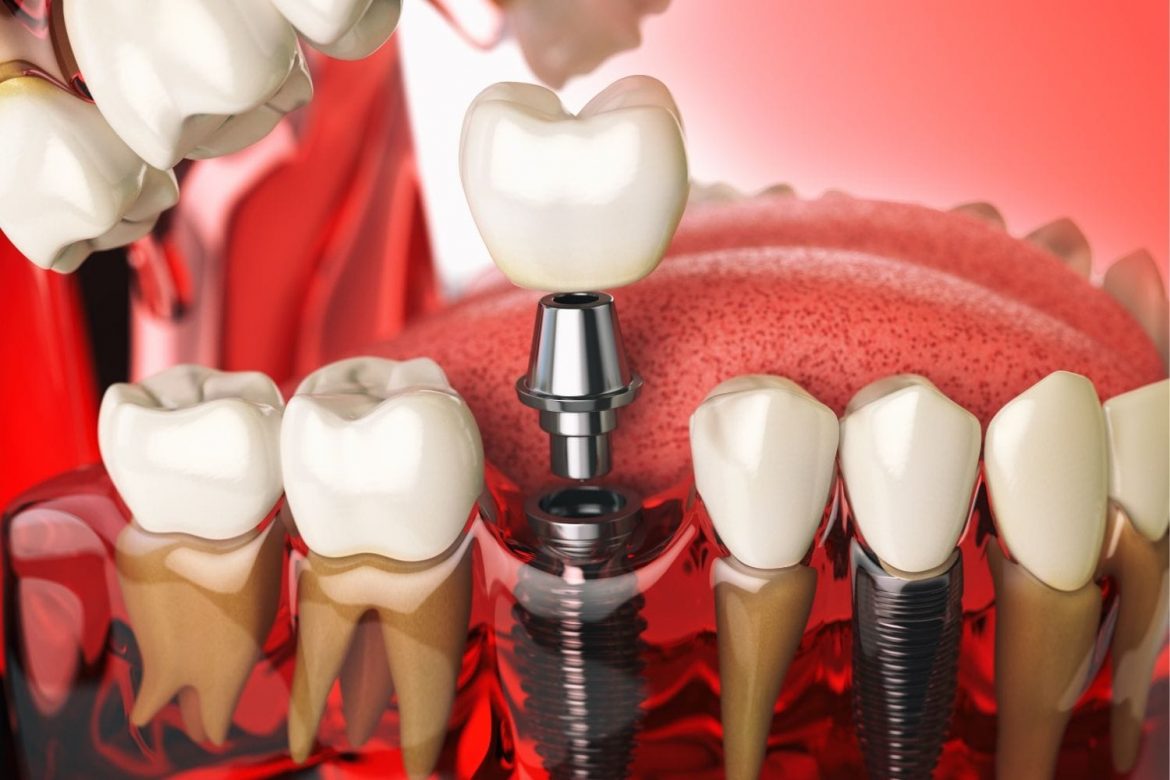 Todo lo que debemos saber de los implantes dentales