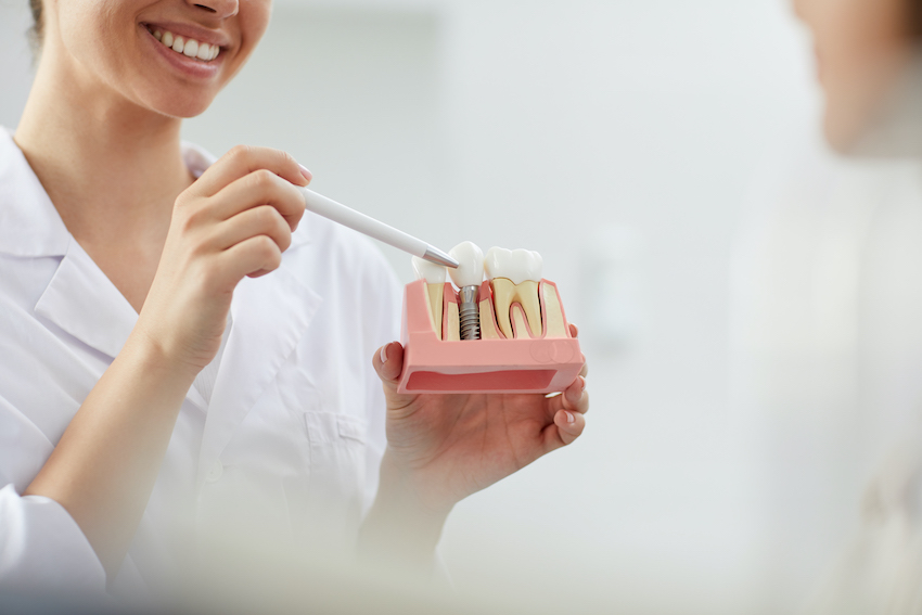 Implante dental unitario, ¿qué es y para qué sirve?