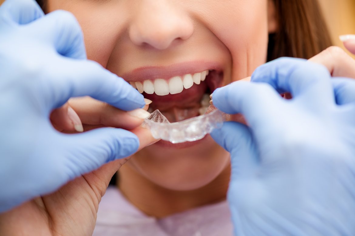 ¿Cómo funciona la ortodoncia invisible?