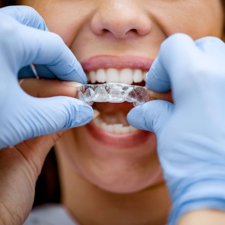 La ortodoncia Invisalign: las dudas más frecuentes