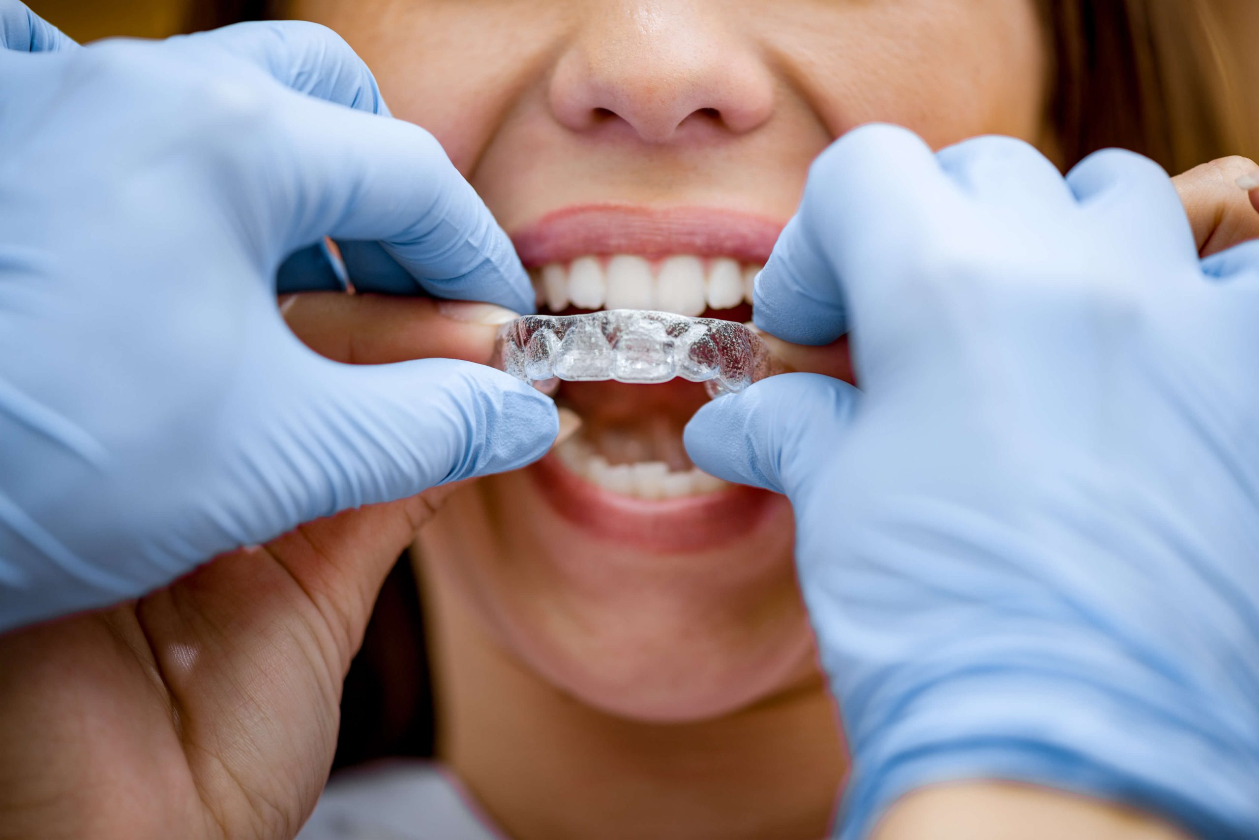 La ortodoncia Invisalign: las dudas más frecuentes