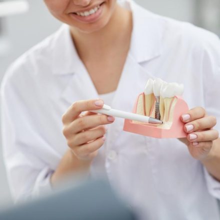 Implantes dentales: resolvemos todas las dudas