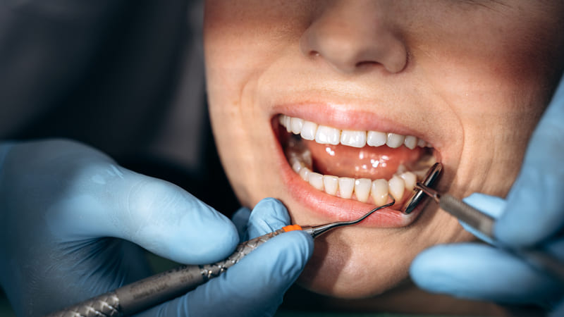 Tratamiento de la gingivitis