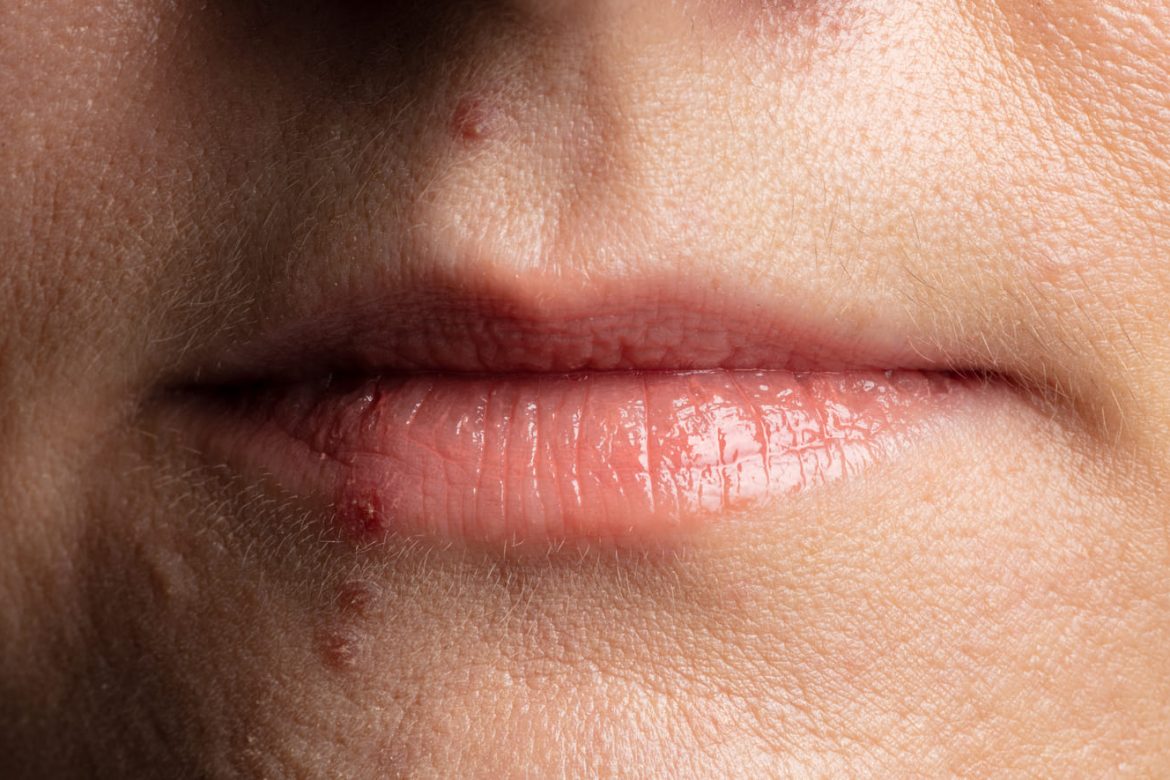 como curar las boqueras