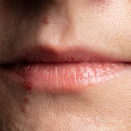 como curar las boqueras