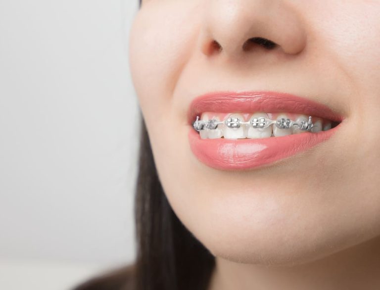 Brackets autoligables o convencionales