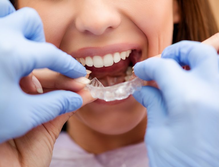 ¿Cómo funciona la ortodoncia invisible?