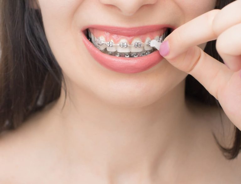 Qué son los brackets autoligables