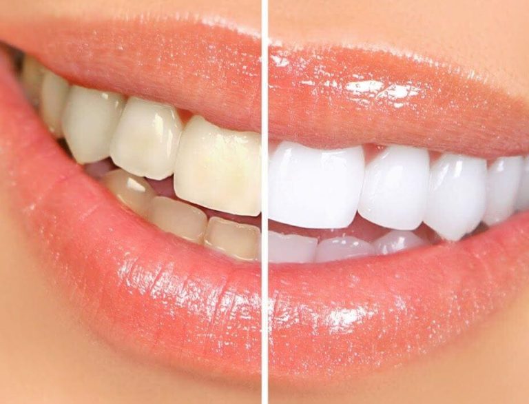 tipos de blanqueamiento dental||dulces en Halloween